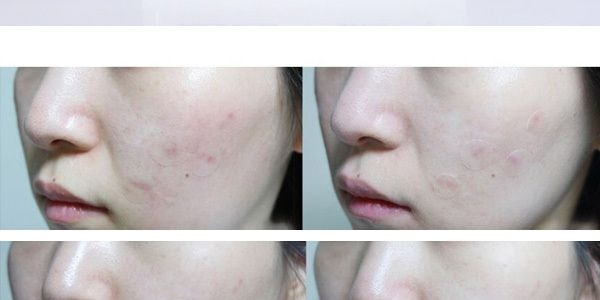 韓國COSRX珂絲艾絲 專效淨痘隱形貼 吸附療癒晚貼 夜間痘痘貼 24貼入